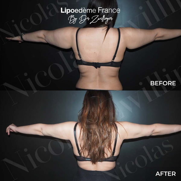 cl2:Didi-lipoedeme-bras-2.jpg