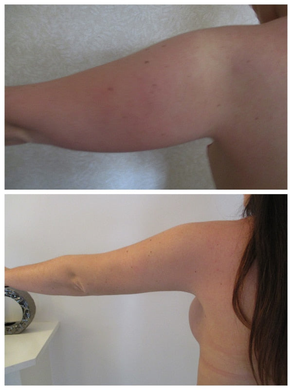 cl2:liposuccion-bras-eviter-lifting-bras.jpg