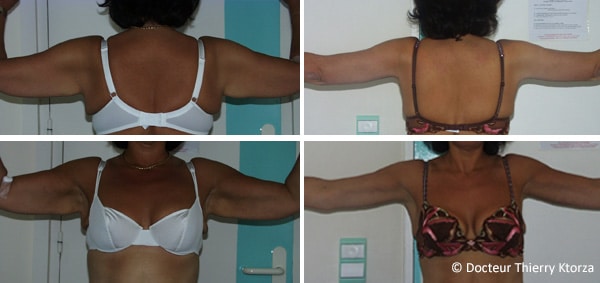 cl2:photo-avant-apres-lifting-bras-perte-de-poids.jpg
